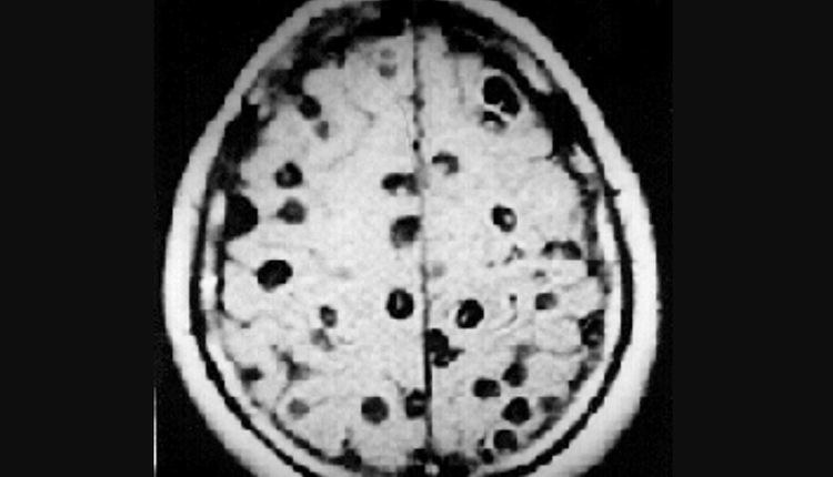 神经囊虫患者的磁力共振扫描（MRI）图像