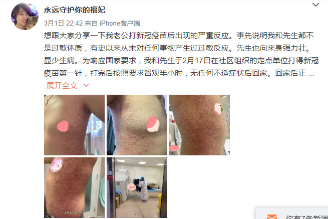 北京男子接種國產疫苗後 高燒並出現大量紅疹