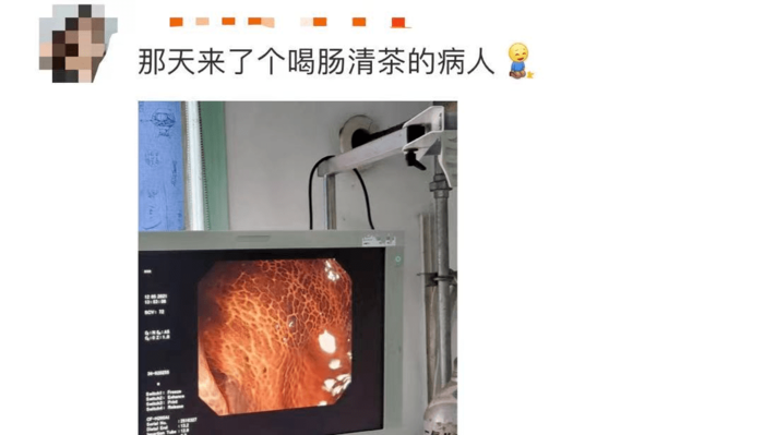 杭州63岁女子长期吃酵素肠子变“蛇皮”